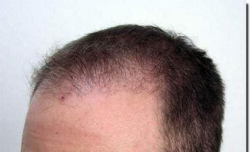 Hair restoration procedure results