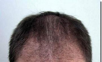 Hair restoration procedure results