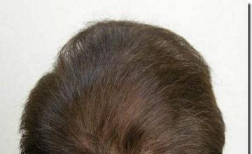 Hair restoration procedure results