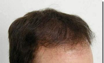 Hair restoration procedure results