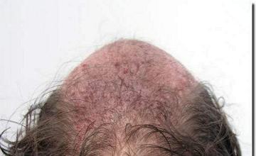 Hair restoration procedure results