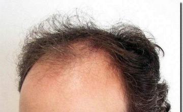 Hair restoration procedure results