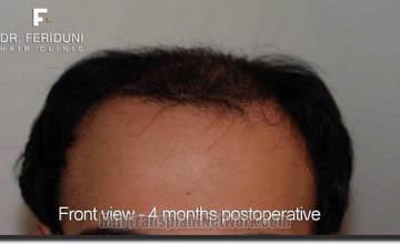 Hair restoration procedure results