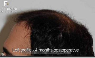 Hair restoration procedure results