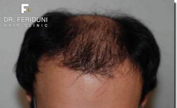 Hair restoration procedure results