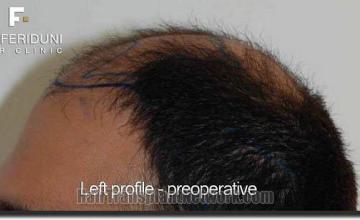 Hair restoration procedure results