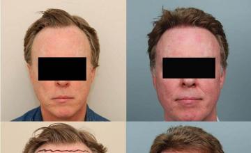 Before and after hair restoration patient photographs