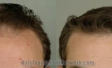 Hair restoration procedure before and after results