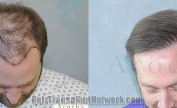 Hair restoration procedure before and after results