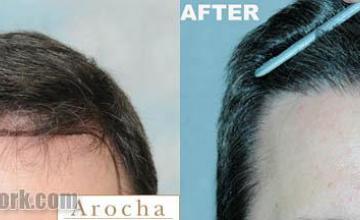 Hair restoration procedure before and after results