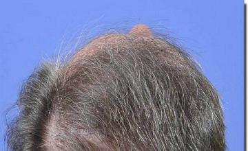 Hair restoration procedure results