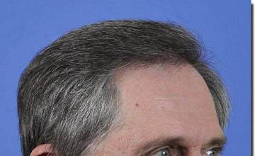 Hair restoration procedure results