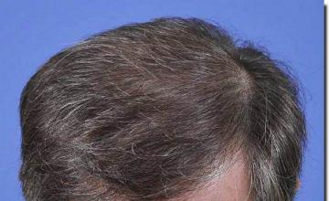 Hair restoration procedure results