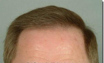 Hair restoration procedure results