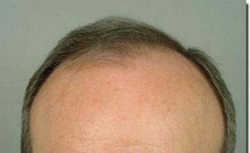 Hair restoration procedure results