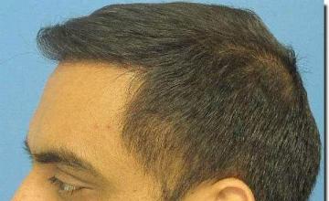 Hair restoration procedure results