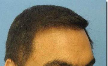 Hair restoration procedure results