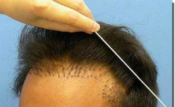 Hair restoration procedure results