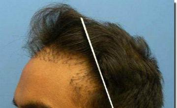 Hair restoration procedure results