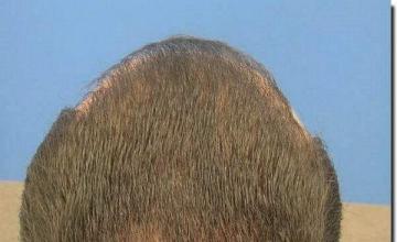 Hair restoration procedure results