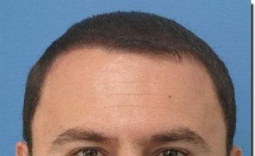 Hair restoration procedure results