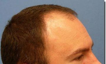 Hair restoration procedure results