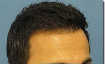 Hair restoration procedure results