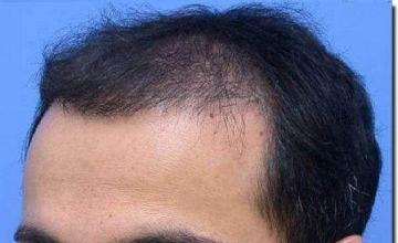 Hair restoration procedure results