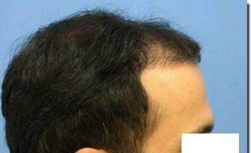 Hair restoration procedure results