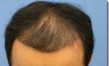 Hair restoration procedure results