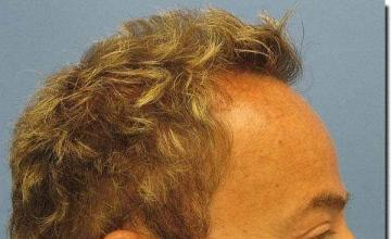 Hair restoration procedure results