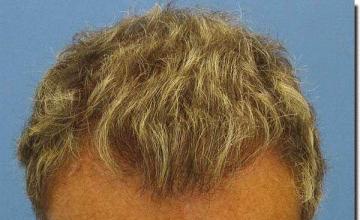 Hair restoration procedure results