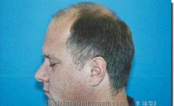 Hair restoration procedure results