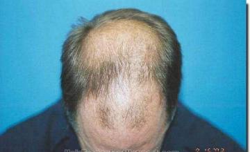 Hair restoration procedure results