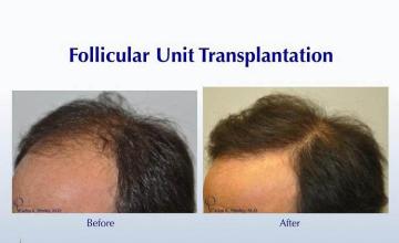 Hair restoration procedure before and after pictures