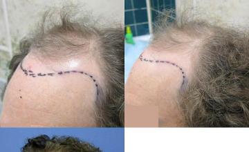 Hair transplantation surgery before and after pictures