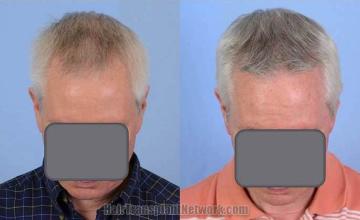 Hair restoration surgery before and after images