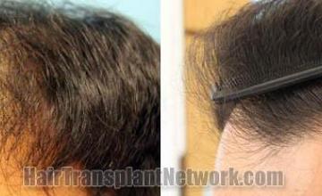 Hair restoration procedure before and after results