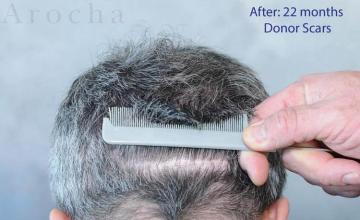 Hair transplantation surgery before and after images