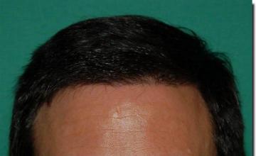 Hair restoration procedure results