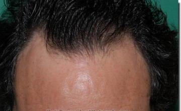 Hair restoration procedure results