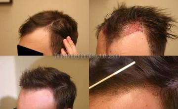 Hair transplantation surgery before and after images