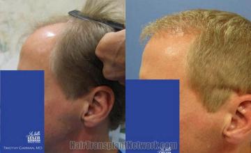 Hair restoration procedure before and after pictures