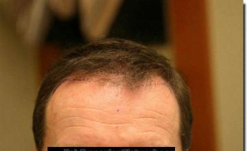 Hair restoration procedure results