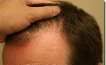 Hair restoration procedure results