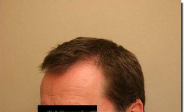 Hair restoration procedure results