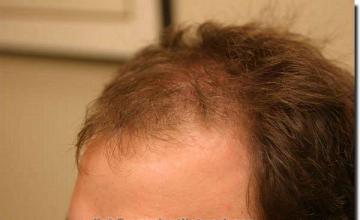 Hair restoration procedure results