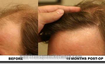 Hair restoration procedure results