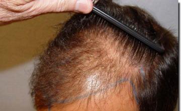 Hair restoration procedure results