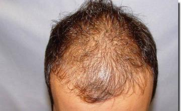 Hair restoration procedure results